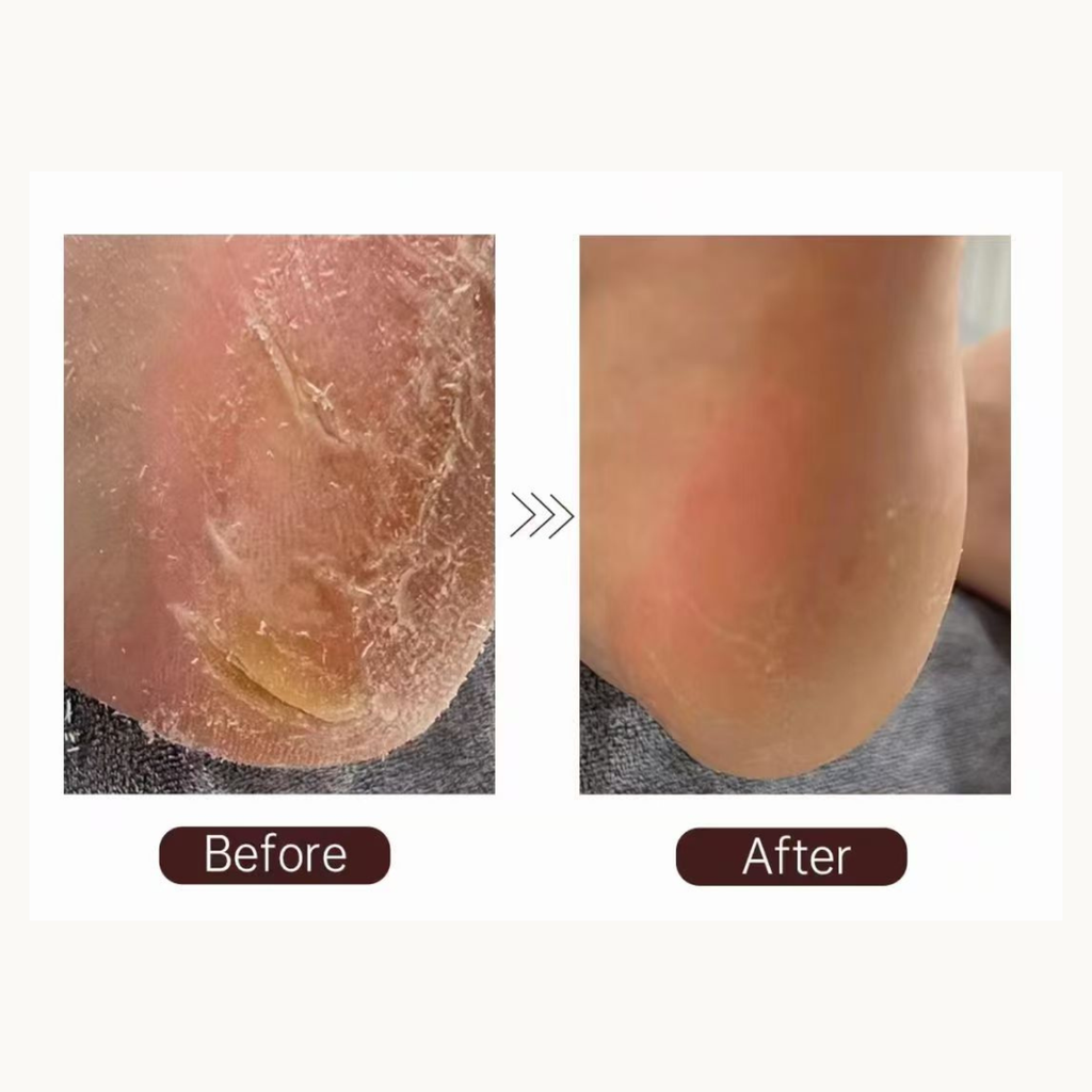 Before and after results of HIGHS foot callus remover showing smoother heels and reduced calluses