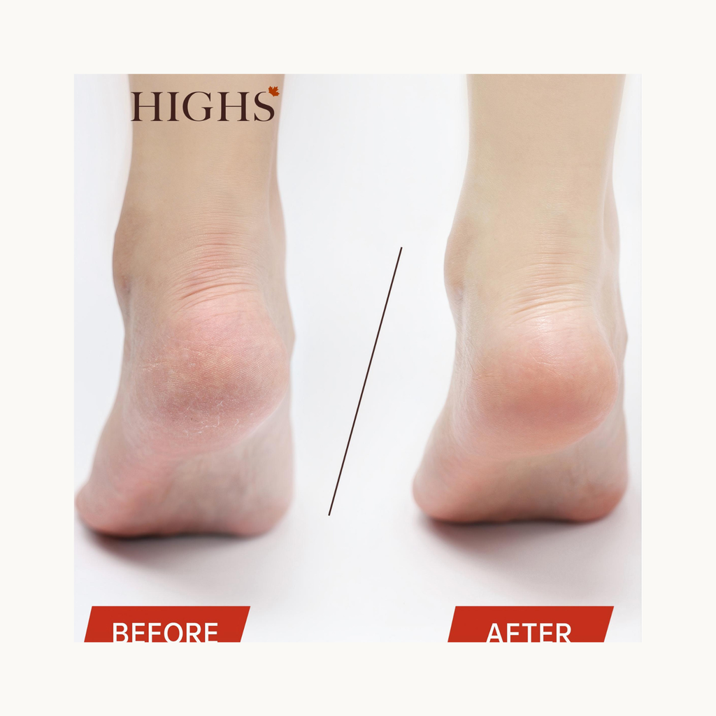 Before and after results showing how HIGHS Mocha Foot Ice Cream softens dry heels, improves rough skin, and reduces cracking